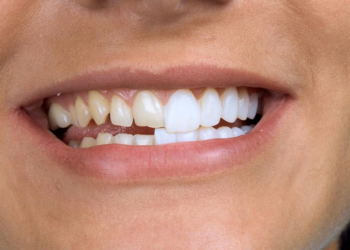 Виниры для зубов: достоинства, разновидности и установка