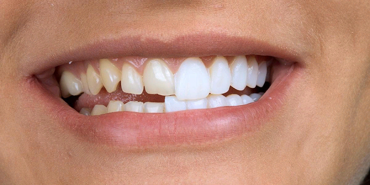 Виниры для зубов: достоинства, разновидности и установка
