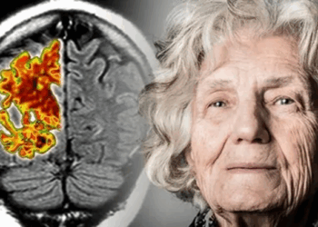 Альцгеймер: основные симптомы и последствия