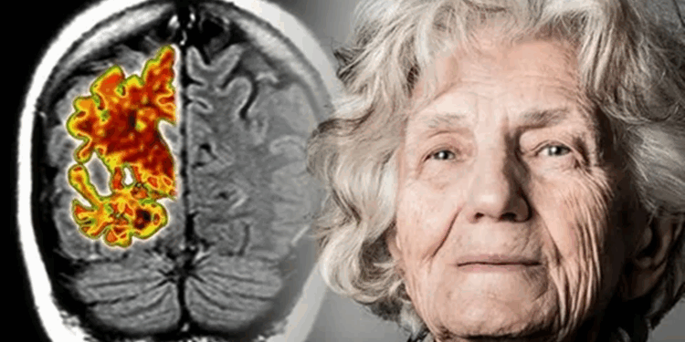 Альцгеймер: основные симптомы и последствия